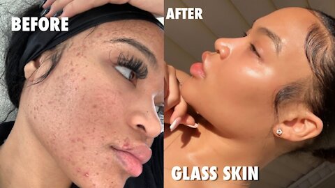 HOW I CLEARED MY ACNE FOR GOOD IN ONE WEEK (NO ACCUTANE) + SKINCARE GIVEAWAY | SKINCARE ROUTINE