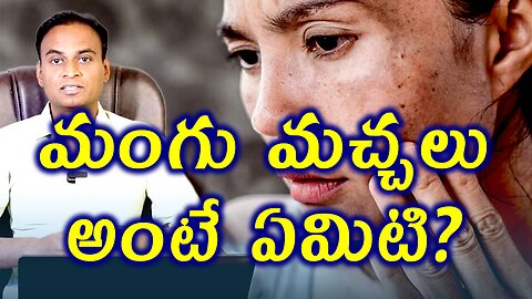 మంగు మచ్చలు అంత ఏంటి? What Is Melasma? Hyperpigmentation | Melasma Treatment & Cure | డా. భరద్వాజ్