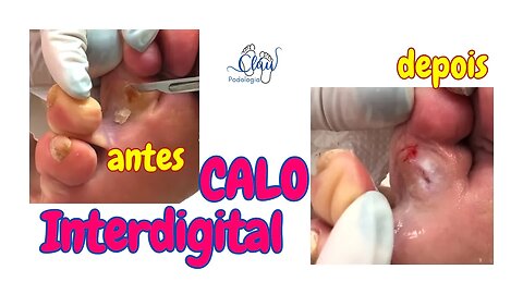 CALO Interdigital retirado com SUCESSO #calos #pes #dor #podologia #procedimento #profissional