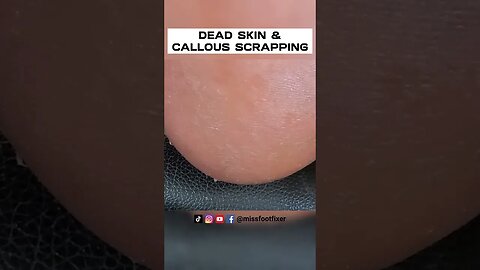 ENORMOUS! DEAD SKIN & CALLOUS SCRAPPING FROM SOLE OF FEET [2023] BY FOOT SPECIALIST MISS FOOT FIXER