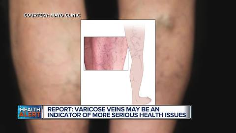 Ask Dr. Nandi: Are varicose veins a warning sign of potentially deadly clots?