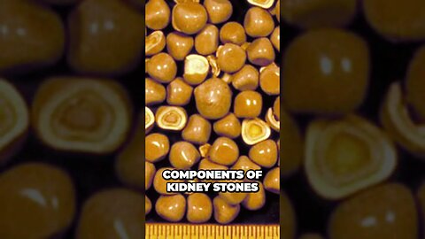 The Astonishing Powers of Citric Acid Unlocking its Secrets for Kidney Stone Prevention
