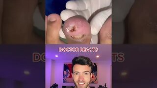 Worst Ingrown Nail I Have Ever Seen
