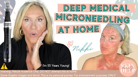 Deep Medical Microneedling At Home - #DIYskincare #microneedling