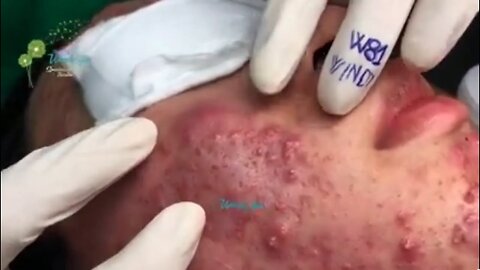 Blackheads Removal | Acne Treatment and Very Satisfying Satisfying Pimple pop #blackheads