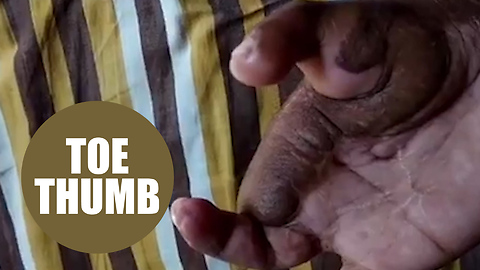 Doctors have successfully replaced a man's thumb with his TOE