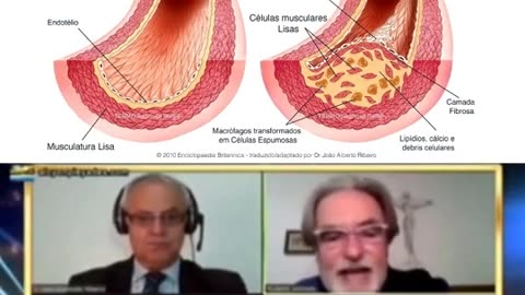 COVID-19 • Vacinas gênicas • Endotelite • MicroTrombose • Vacina experimental (2023,11,17) 👀🔥☢️