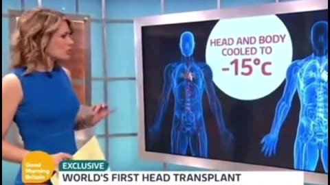 World First Head Transplant