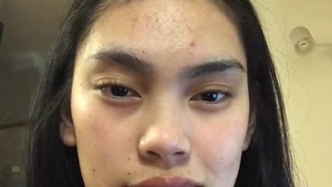 Inang pimples ayaw ako tantanan