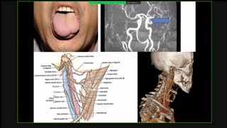 ST4.40 year old lady with difficulty speaking