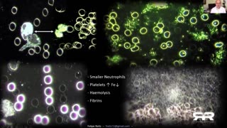 Thermographic Imaging Shows Massive Blood Clots in the Asymptomatic Vaxxed