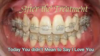 Brace Treatment