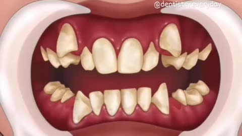 Simulation of the tooth repair process
