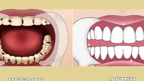 Tooth Caries Removal so Satisfying