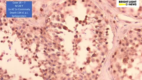 Pathologist Arne Burkhardt, studying mRNA spike proteins being expressed in testes.