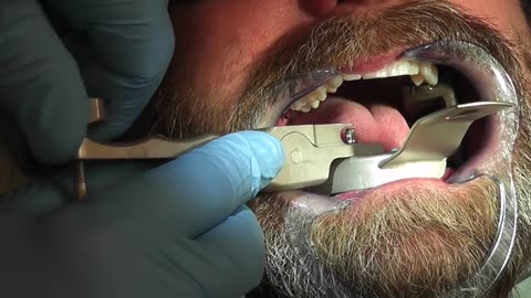 Easy tooth extraction