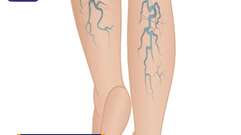 Homeopathic Medicine & Treatments for Varicose Veins
