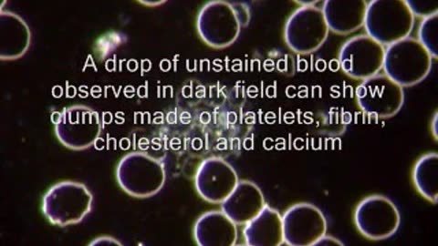 Thrombosis and cardio-vascular diseases