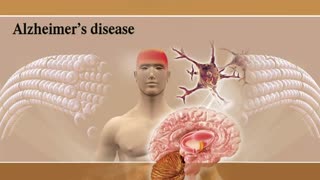 Alzheimer Disease