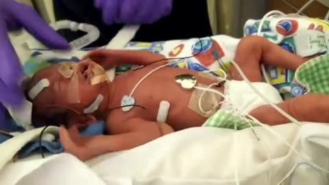 Adorable PREEMIE Baby Crying after Eye Mask is Removed in NICU