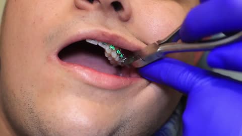 (Spanish) Trimming Dental Wire - Sky Ortho