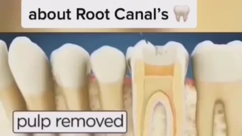 Dark Truth About Root Canals