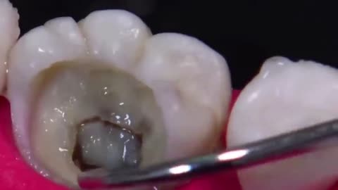 The whole process of filling teeth