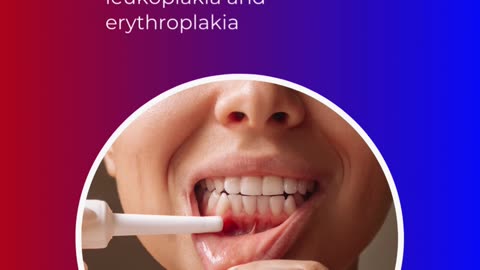 Oral Cancer Signs | DentaCare Dental Clinic | Best Dental Clinic in Bannerghatta Road | Best Dentist