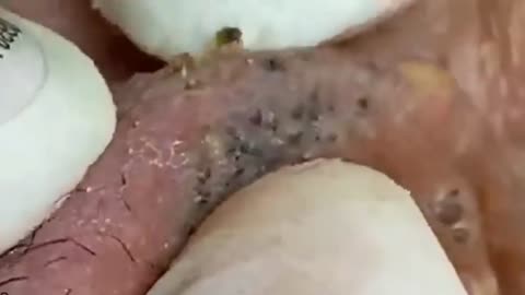 Blackheads & Milia, Big cystic acne blackheads extraction whiteheads Removal Pimple Popping.