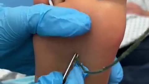 Leg treatment, surgery