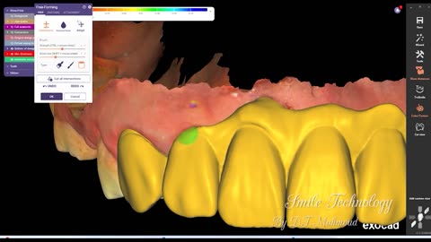 How to design 6 anterior teeth with gingiva dental design by exocad