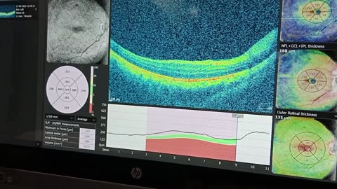 OCT Macula ( cystoid Macular edema)