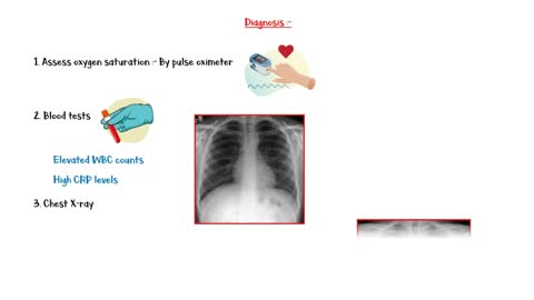 Pneumonia [Overview] - Causes, Types, Signs & Symptoms, Diagnosis & Treatment [Patient Education]