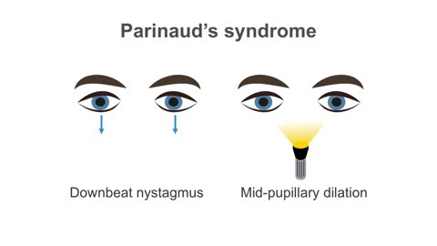 Clinical Neurology Essentials 3.Revealing the mysteries of the midbrain