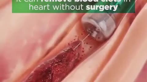 Removing blood clots within surgery now possible…