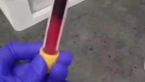 This blood taken from a "vaccinated" patient. After three minutes STARTED Clotting! It usually takes 30 minutes for blood to clot in an SST tube, not 3 minutes.
