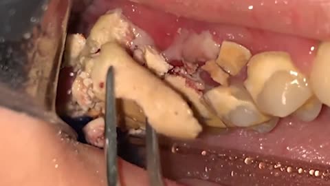Scaling teeth