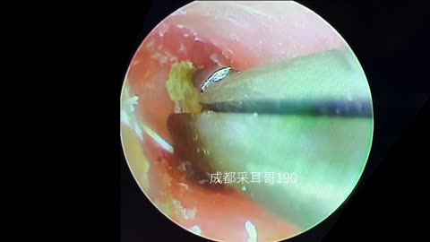gigantic ear wax removal #41
