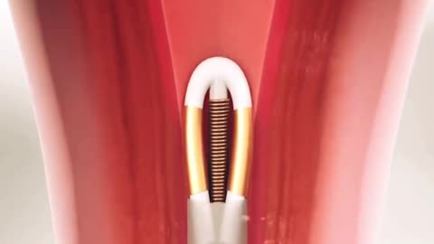 How Hormonal IUD is Placed 3D Animation