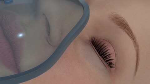 eyelid surgery