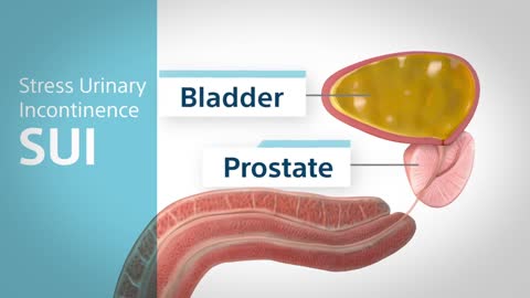 SUI and Prostate Cancer Animation