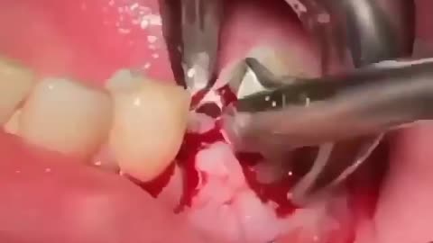 Extración de dientes