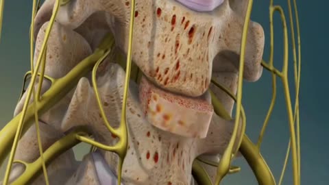 Spinal Cord Surgery 3D Animation