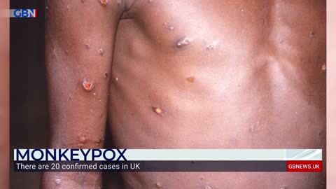 Monkeypox: Currently 20 confirmed cases in the UK | Imperial College Professor discusses