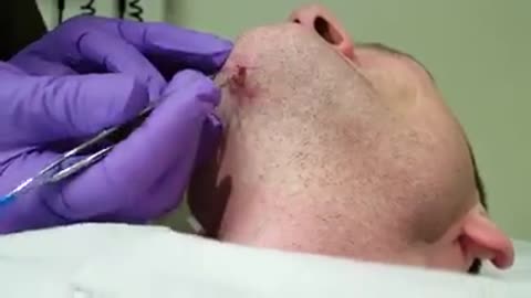 Ingrown Hair