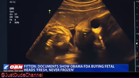 ORRORI: la FDA di Obama ha acquistato teste di bambino abortite