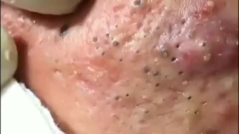 Best Blackheads Removal video