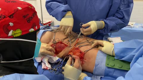 Lateral Vertical Abdominoplasty -- “Hourglassing”