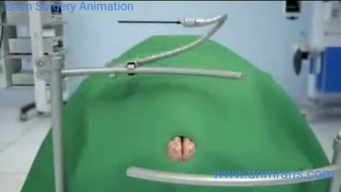 Brain surgery animation