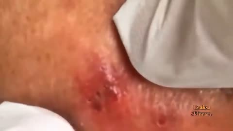 Extremely satisfying blackhead and whitehead removal 1